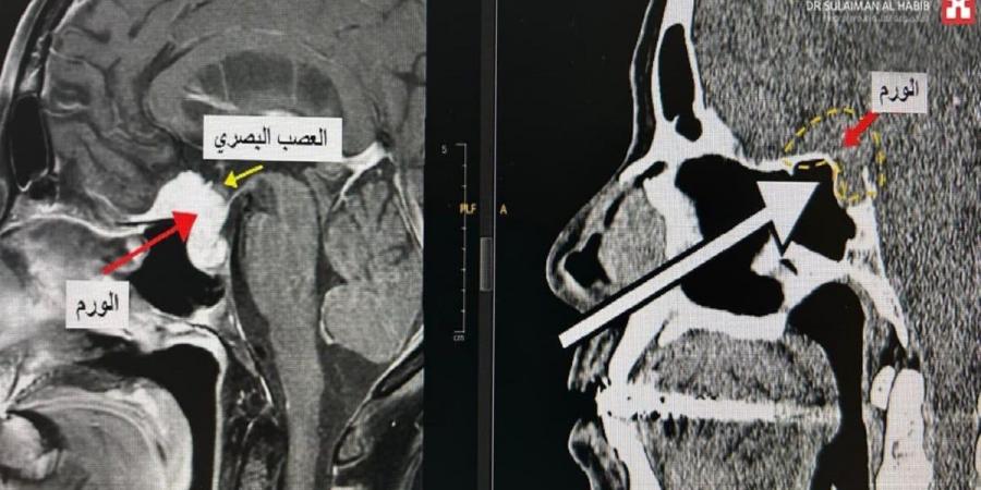 مستشفى الدكتور سليمان الحبيب بالفيحاء في جدة يُنهي معاناة ستينية مع ورم دماغي بقاع الجمجمة - عرب فايف